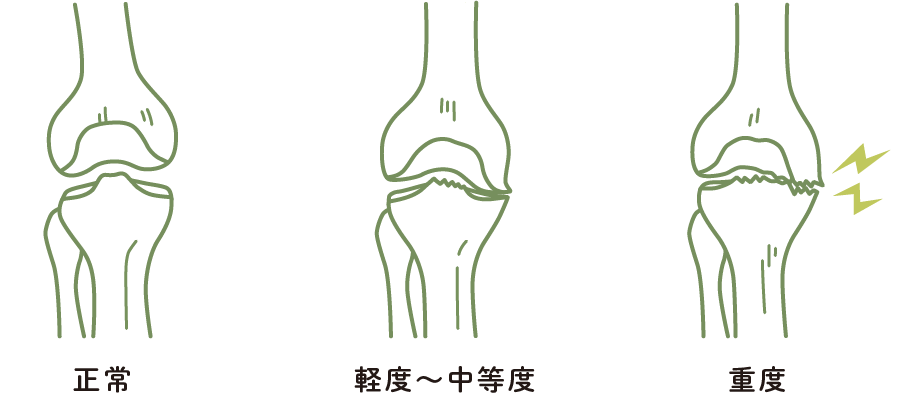 膝の痛み（変形性膝関節症）の進行度合いと痛み