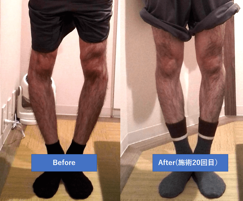 男性 重度のｏ脚も矯正できる 実例レポート 小石川整骨院