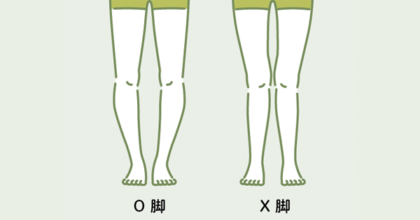 X脚 O脚の原因と矯正方法 東京でxo脚矯正の病院をお探しなら小石川整骨院